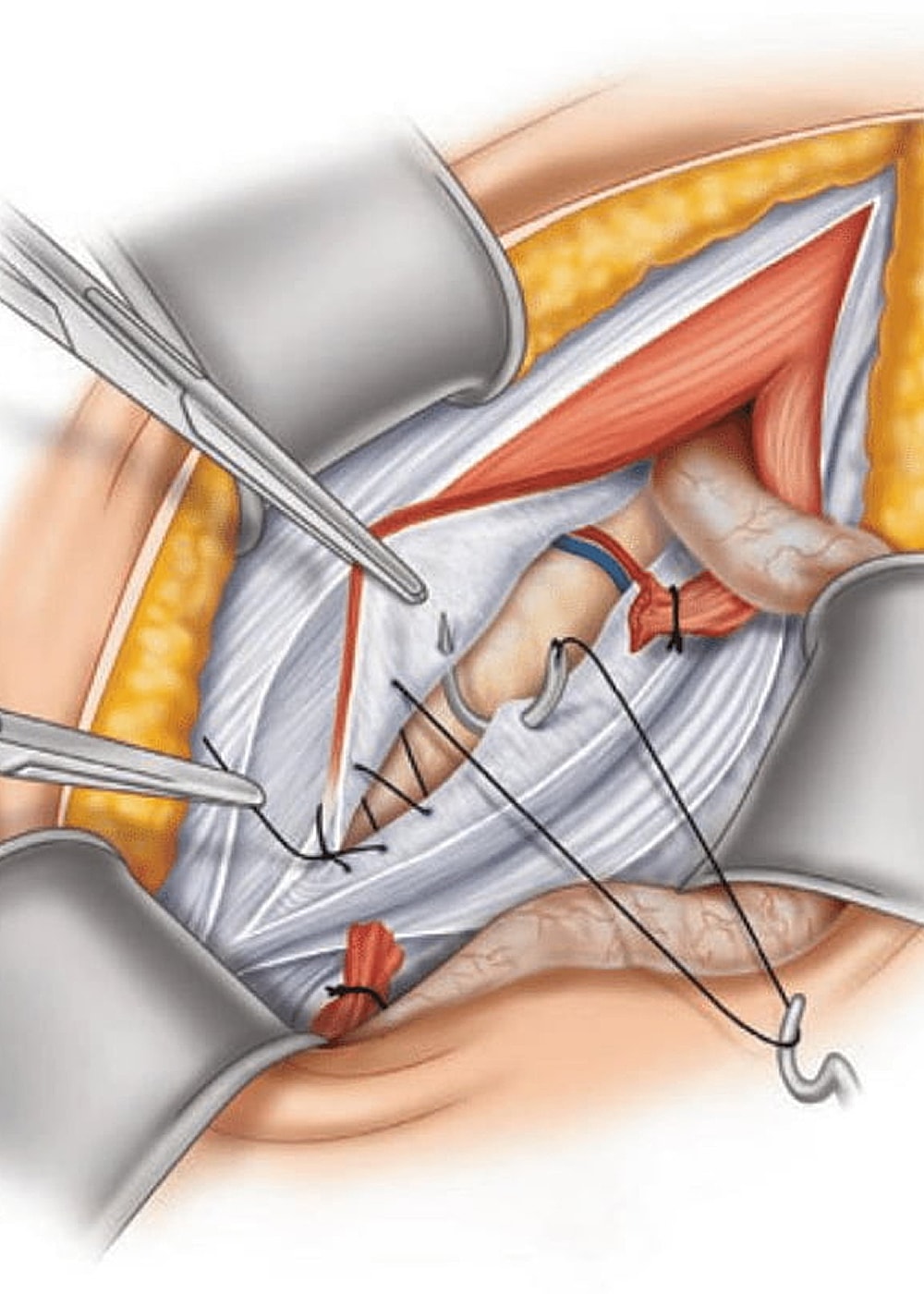 Surgical procedure illustrating NYC minimally invasive surgery.